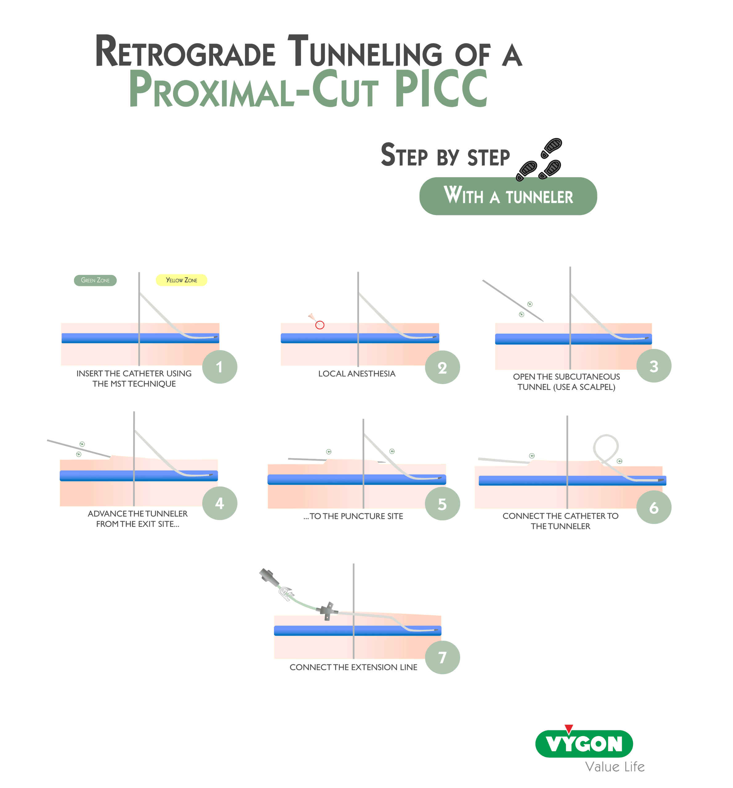 Retrograde Tunneling of a Proximal‑Cut PICC