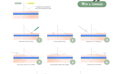 Retrograde Tunneling of a Proximal-Cut PICC
