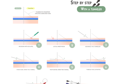 Retrograde Tunneling of a Proximal-Cut PICC