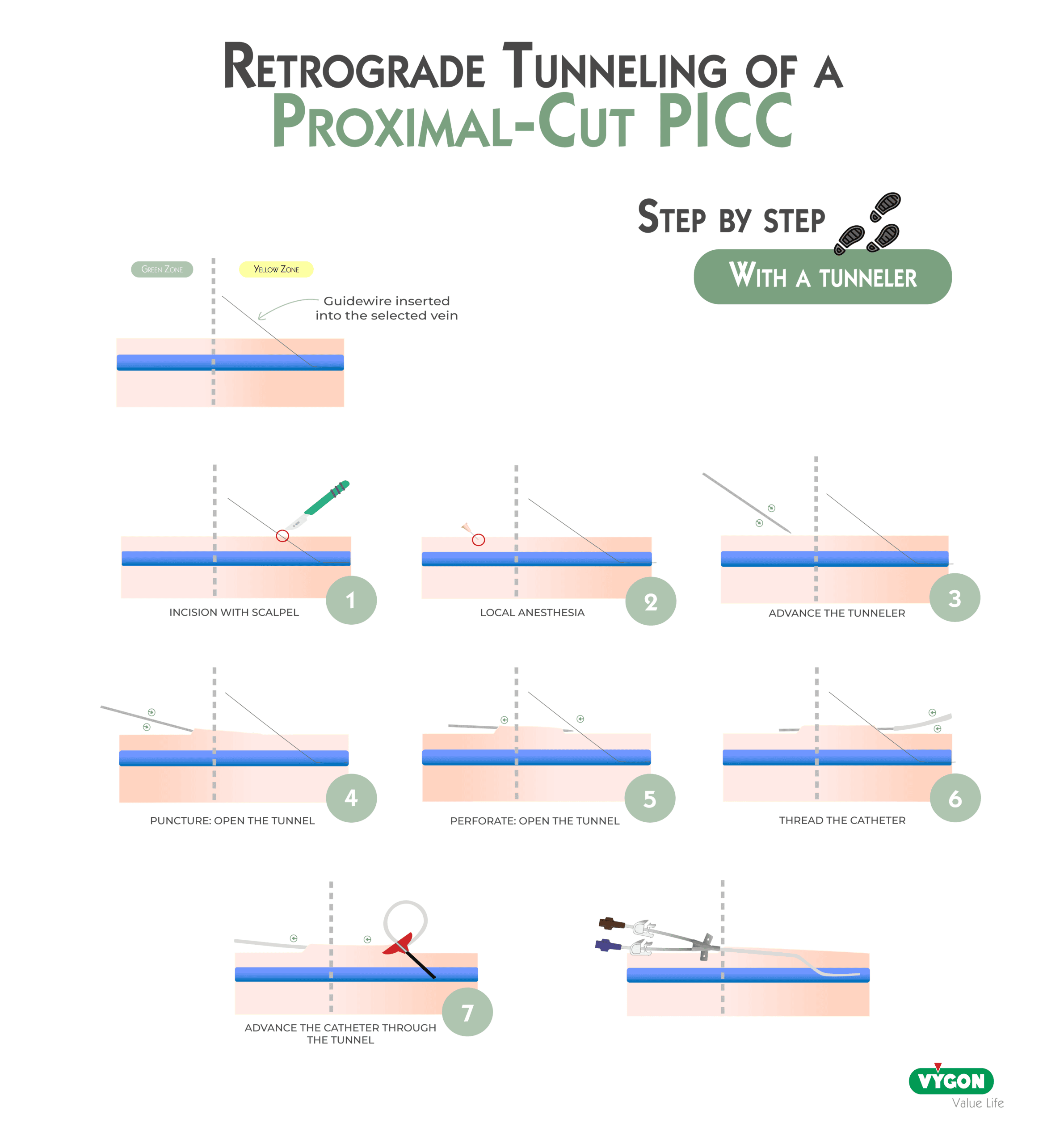 Retrograde Tunneling of a Proximal‑Cut PICC