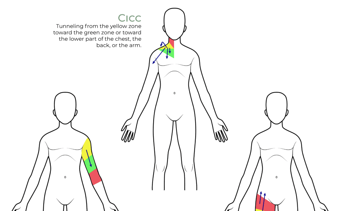 Tunneling Possibilities According To The Type of Central Venous Access