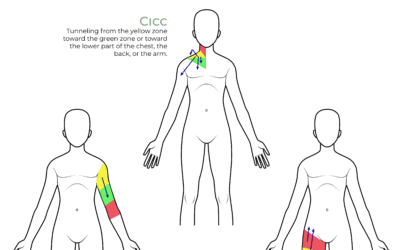 Tunneling Possibilities According To The Type of Central Venous Access