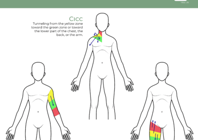 Tunneling Possibilities According To The Type of Central Venous Access