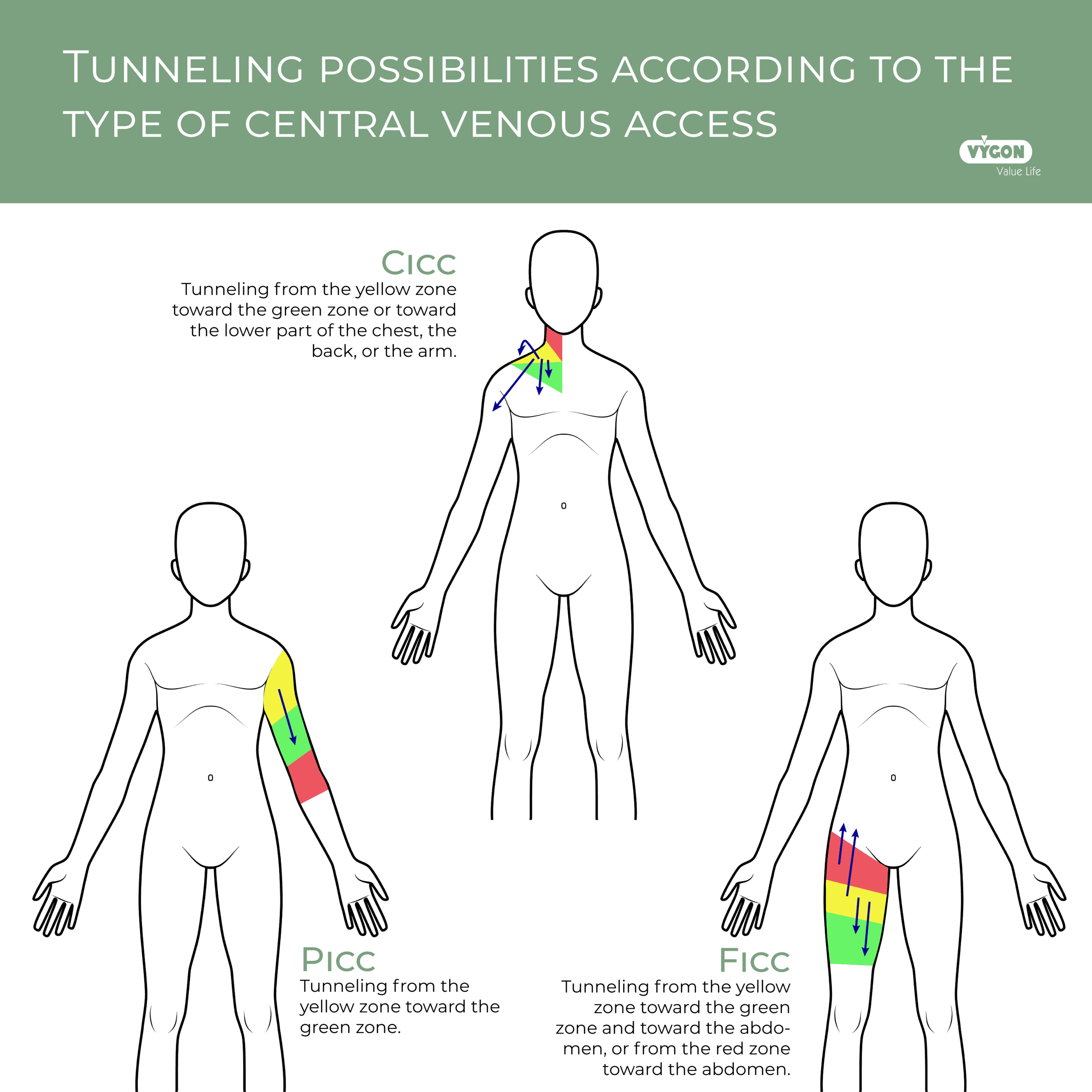 Tunneling possibilities according to the type of central venous access