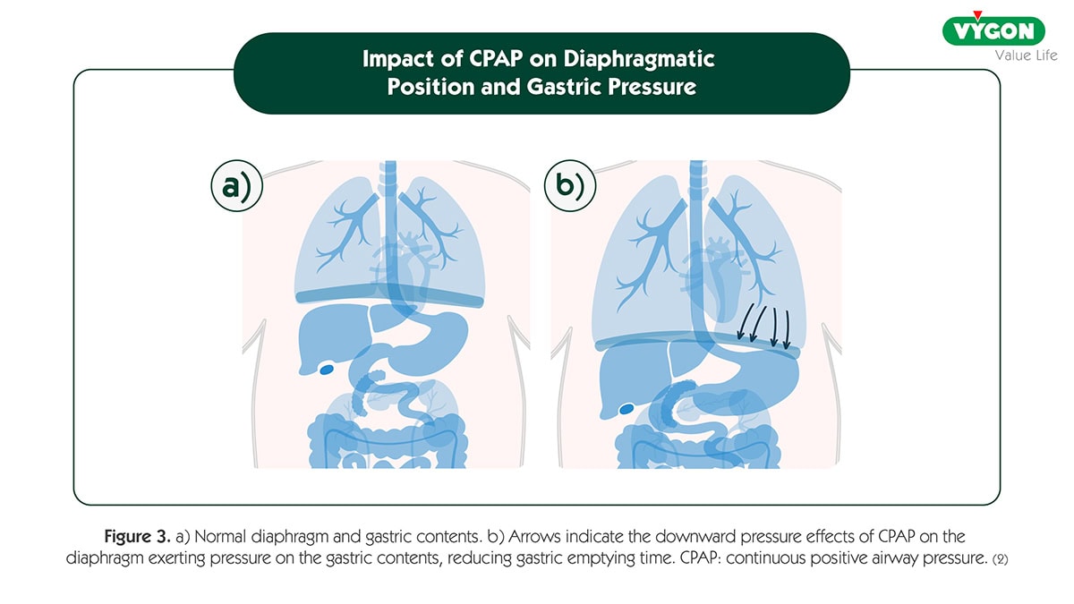 Medical infographic illustrating the impact of Continuous Positive Airway Pressure (CPAP) on diaphragmatic position and gastric pressure. Side-by-side anatomical diagrams compare a normal diaphragm and stomach position with the downward pressure effects caused by CPAP, showing diaphragm displacement and increased pressure on gastric contents, which may reduce gastric emptying time in neonatal and respiratory care settings.
