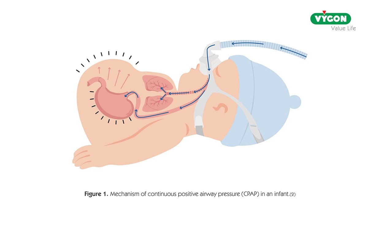 Mechanism of continuous positive airway pressure (CPAP) in an infant. Continuous Positive Airway Pressure (CPAP) mechanism in a newborn infant. Medical illustration showing nasal CPAP airflow maintaining positive airway pressure, promoting lung expansion, increasing functional residual capacity, preventing alveolar collapse, and supporting neonatal respiratory function in premature and critically ill infants.