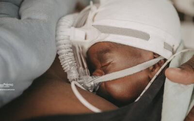 Beyond Breathing: The Impact of CPAP Belly Syndrome on Feeding and Nutrition in the NICU