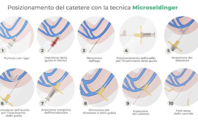 Posizionamento del catetere con la tecnica Microseldinger