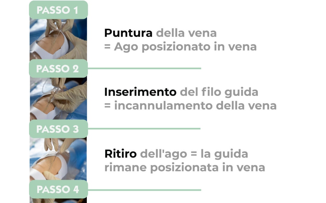 Tecnica di Seldinger in 4 passi
