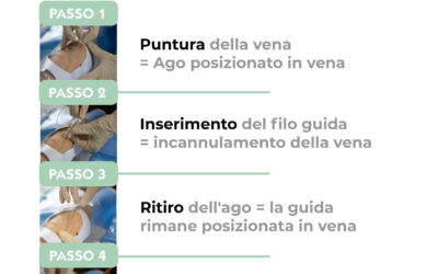 Tecnica di Seldinger in 4 passi