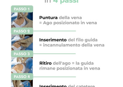 Tecnica di Seldinger in 4 passi