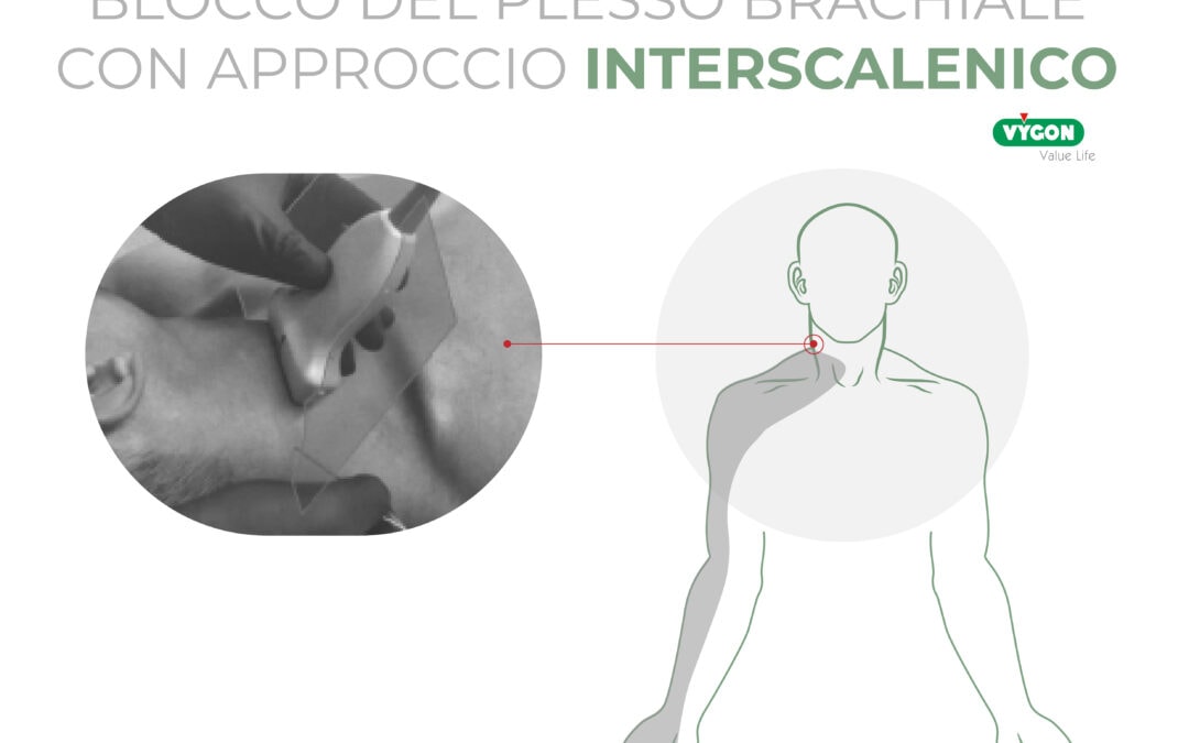 Blocco del plesso brachiale con approccio interscalenico