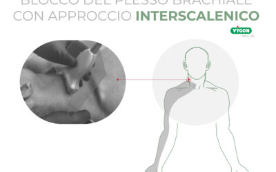 Blocco del plesso brachiale con approccio interscalenico