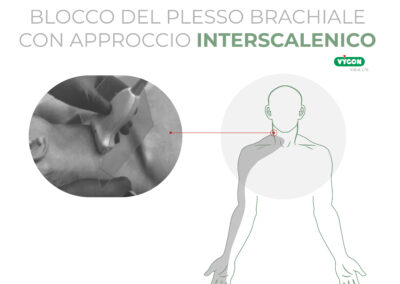 Blocco del plesso brachiale con approccio interscalenico