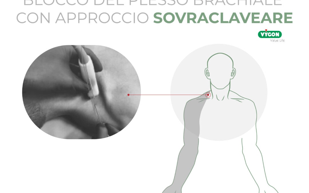 Blocco del plesso brachiale con approccio sovraclaveare