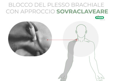 Blocco del plesso brachiale con approccio sovraclaveare