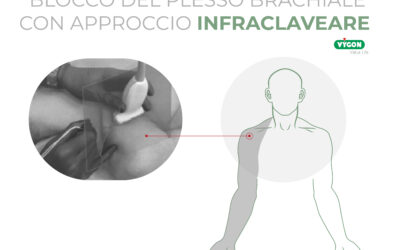 Blocco del plesso brachiale con approccio infraclaveare