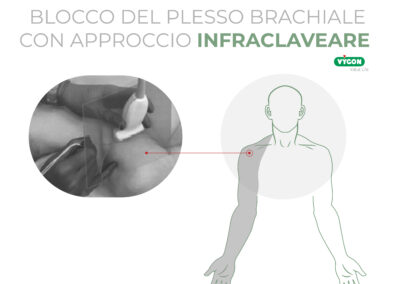 Blocco del plesso brachiale con approccio infraclaveare