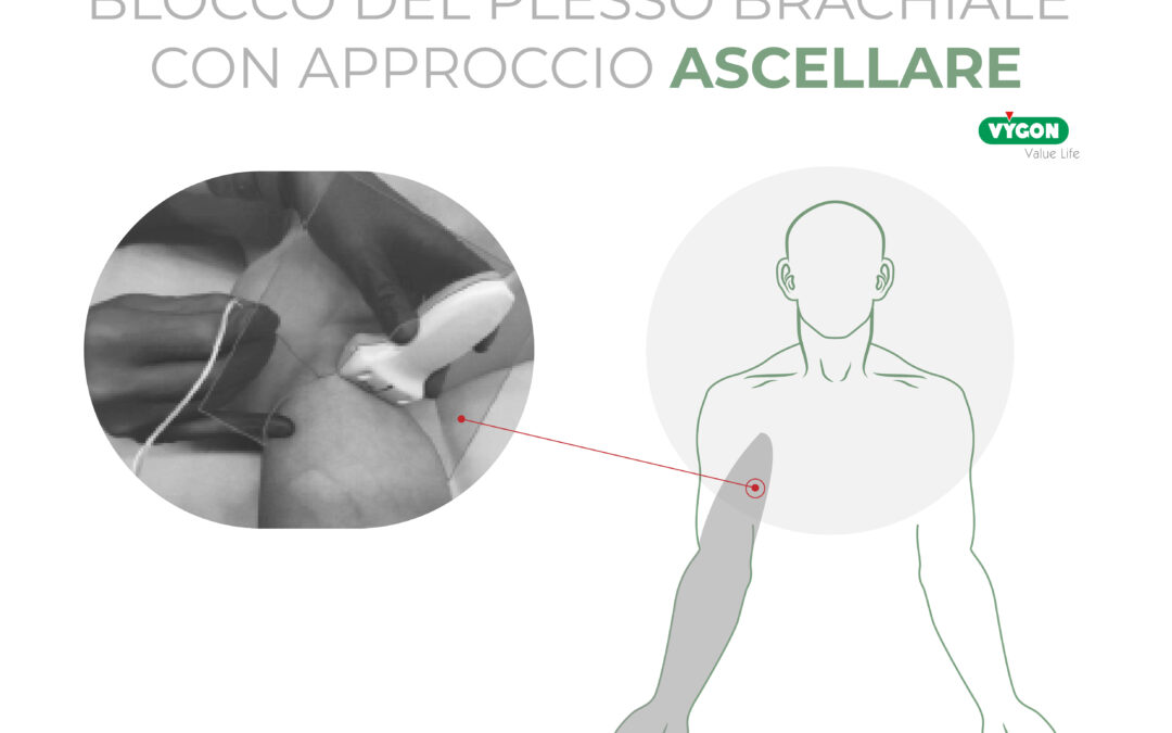 Blocco del plesso brachiale con approccio ascellare