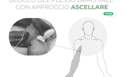 Blocco del plesso brachiale con approccio ascellare
