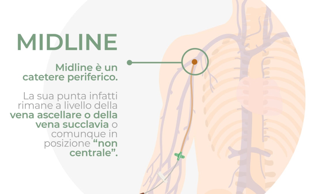 Catetere periferico – Midline