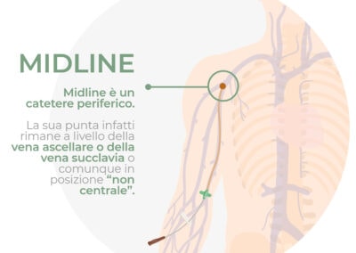 Catetere periferico – Midline