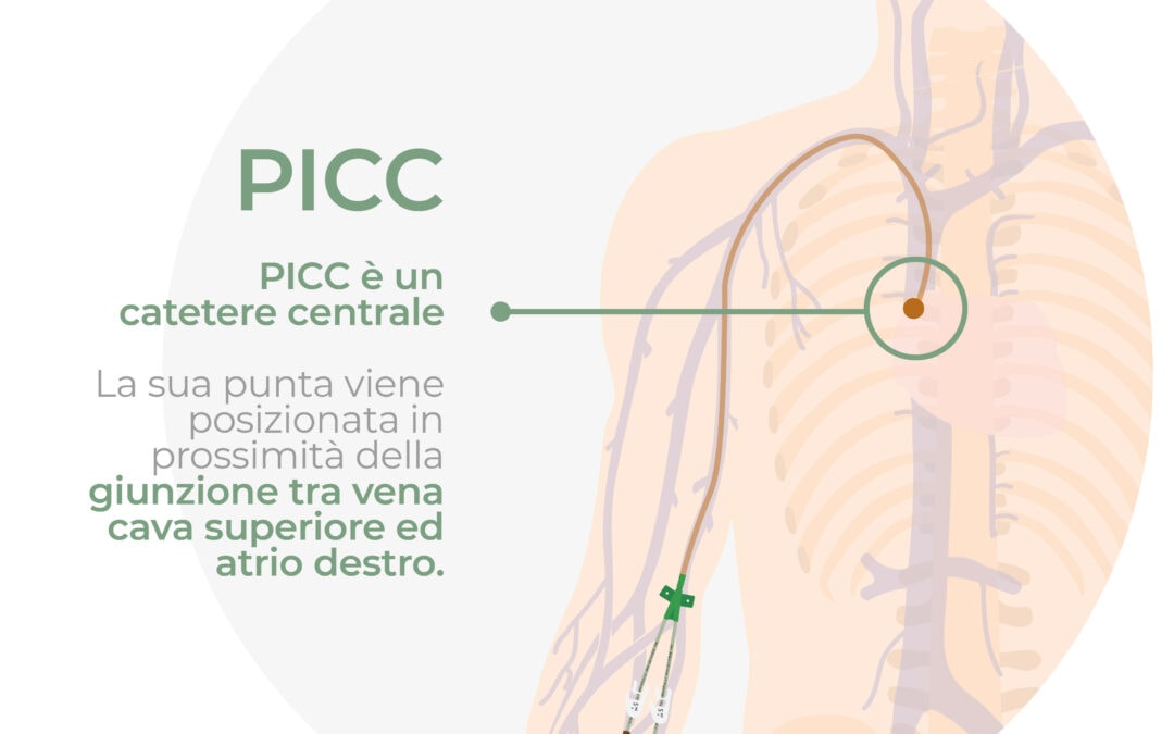 Catetere centrale – PICC
