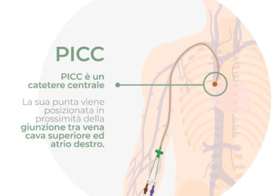 Catetere centrale – PICC