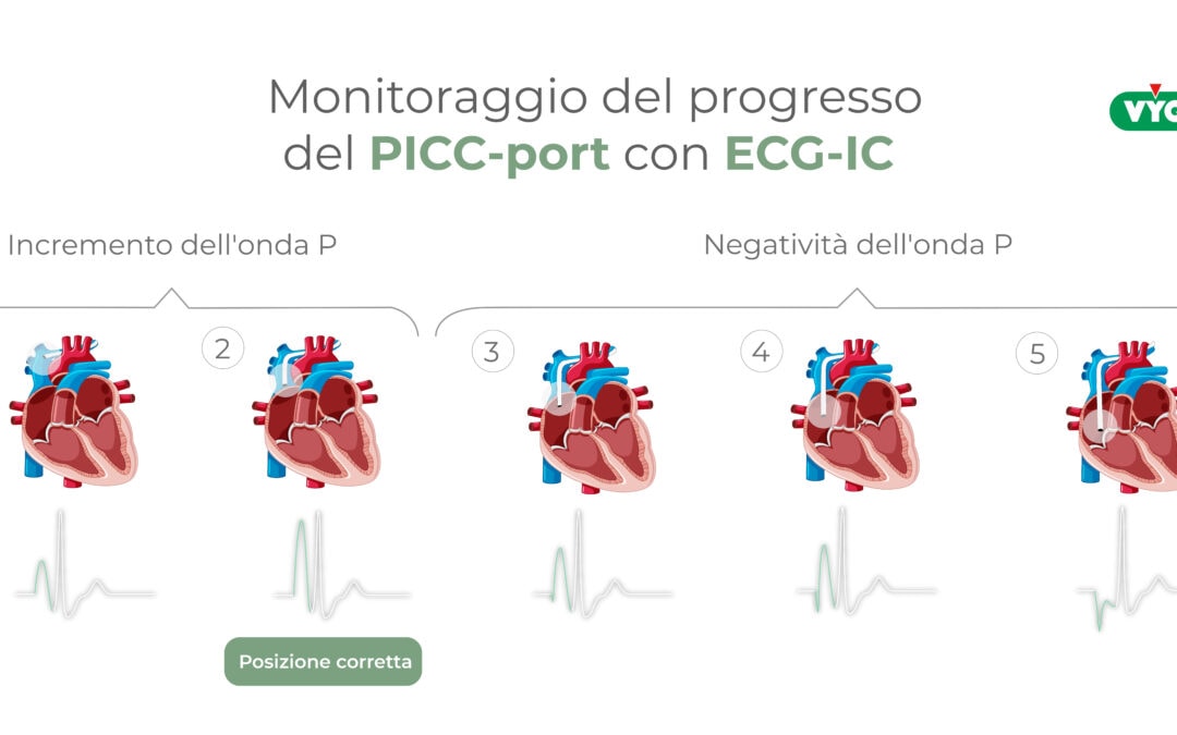 Monitoraggio del progresso del Picc-port con ECG-IC