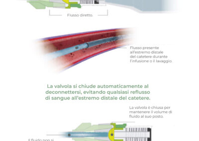 Connettori needleless: valvole antiriflusso