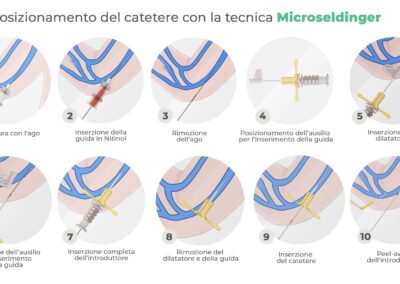 Posizionamento del catetere con la tecnica Microseldinger