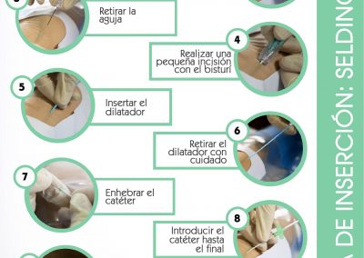 Póster técnica de inserción seldinger pura