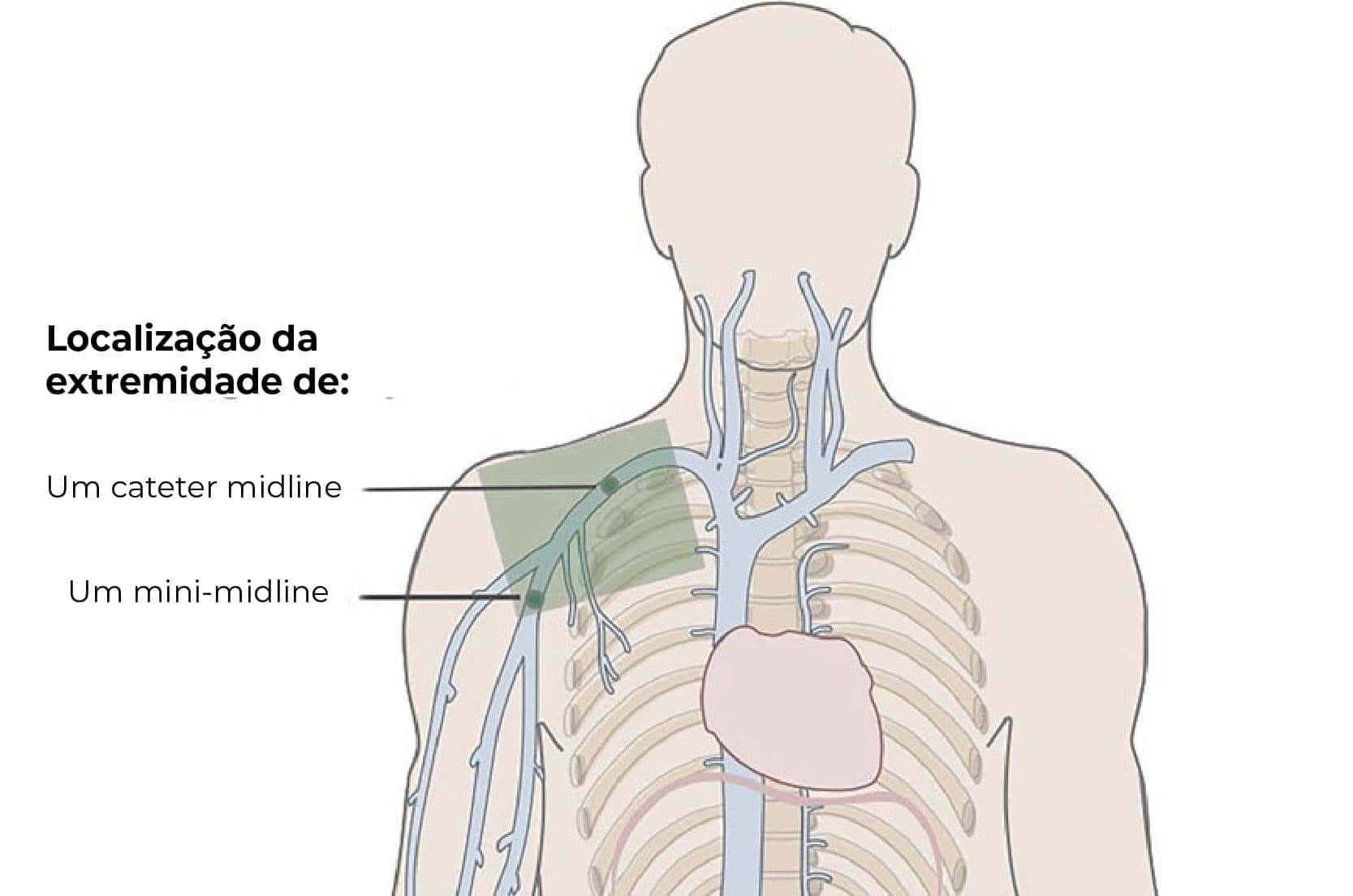 Anatomia e localização da extremidade dos cateteres midline e mini-midline.