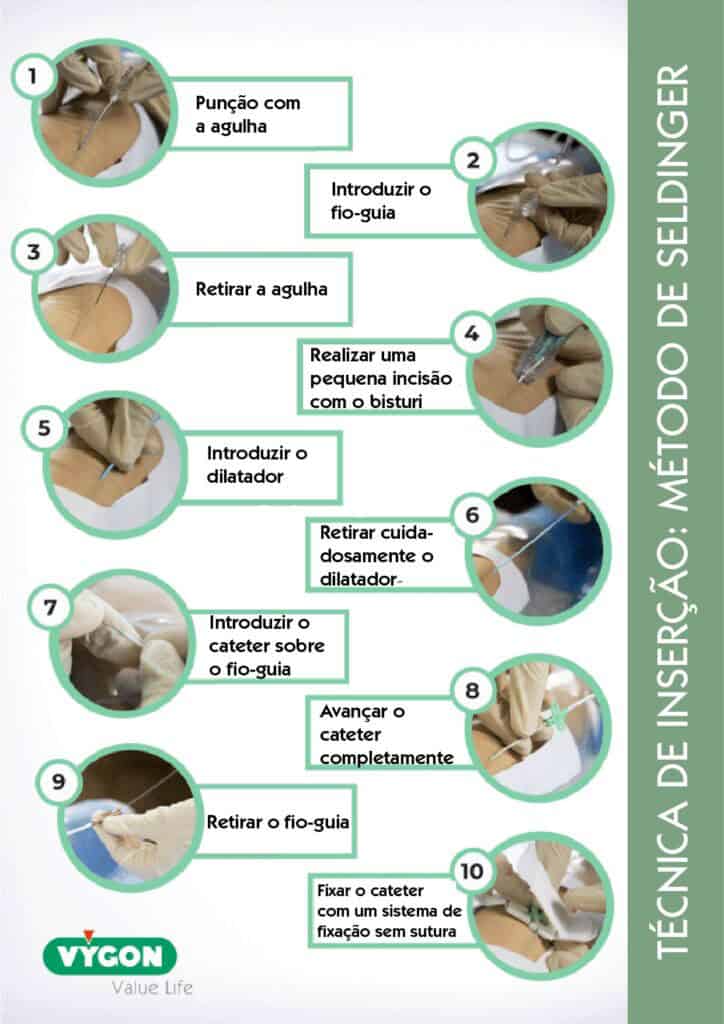 Passo a passo da técnica de inserção de cateter pelo método de Seldinger.