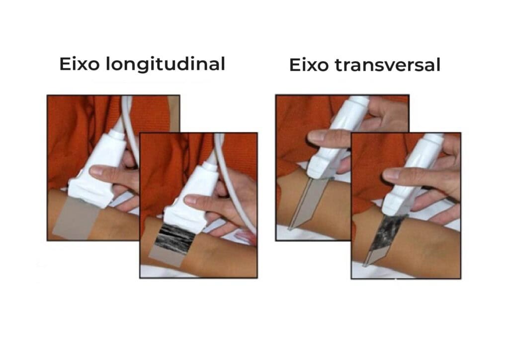 Comparação entre eixo longitudinal e transversal na ecografia para inserção de cateter.