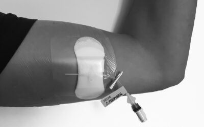 Cateter Midline: protocolo de colocação e manutenção