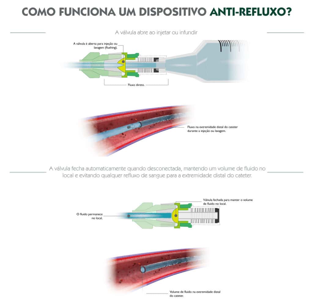Esquema explicativo do funcionamento de um dispositivo anti‑refluxo em cateteres venosos.