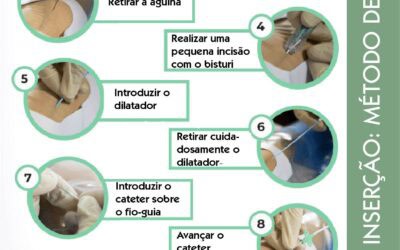 Técnica de Seldinger: passo a passo na inserção de cateter