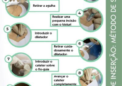 Técnica de Seldinger: passo a passo na inserção de cateter