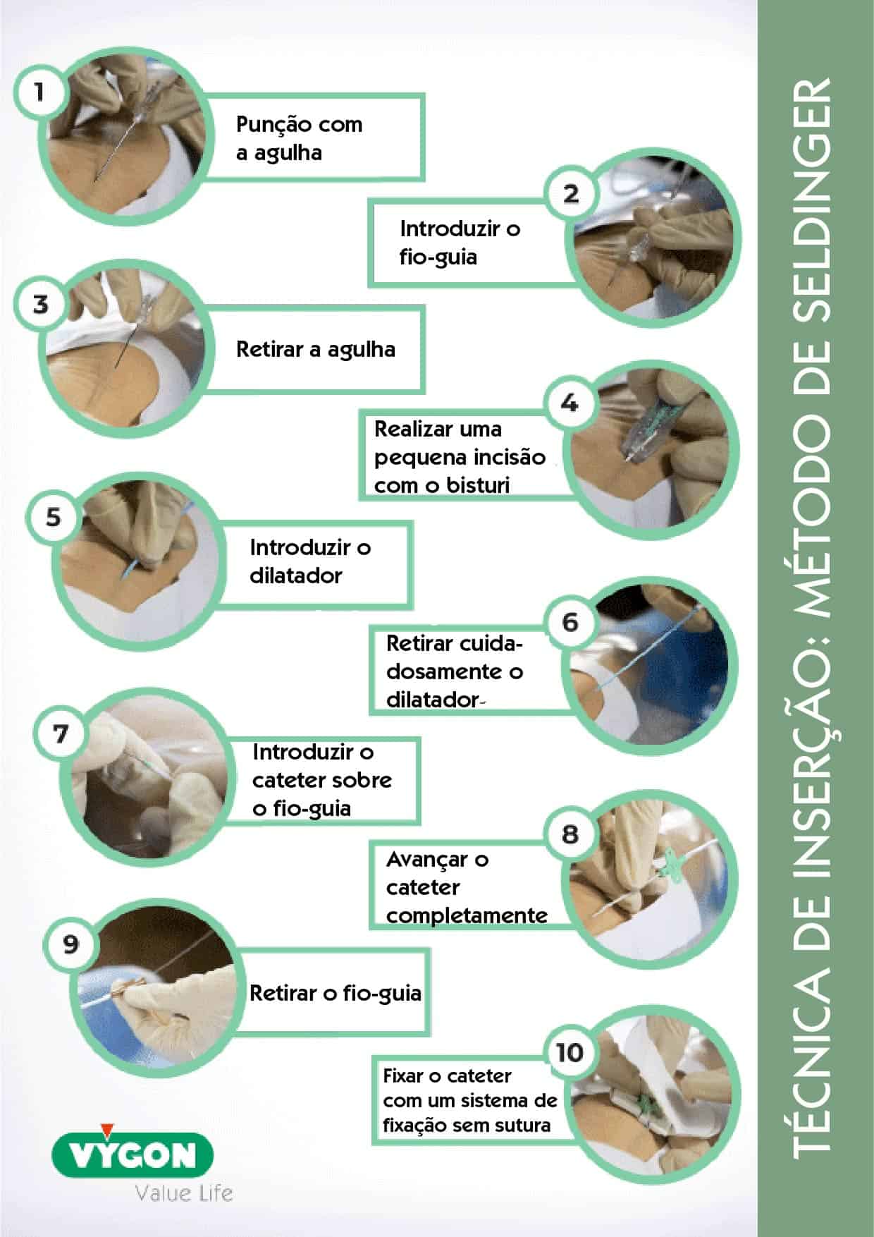 Infografia da técnica de Seldinger com etapas de inserção de cateter, incluindo punção, introdução do fio‑guia, dilatação e fixação final.