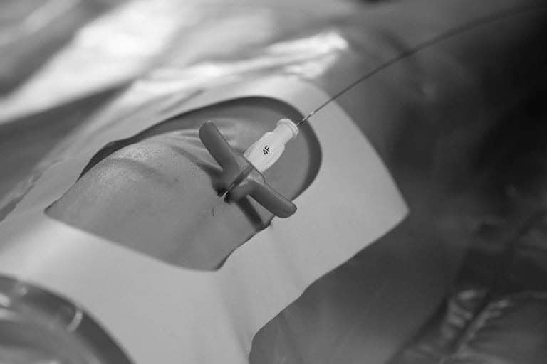 Técnica de Seldinger: quando utilizar o método clássico ou o método modificado