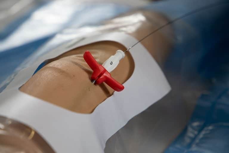 Técnica de Seldinger: quando utilizar o método clássico ou o método modificado 2 Micro‑introduzor e guia metálica utilizados na técnica Micro Seldinger para acesso vascular.
