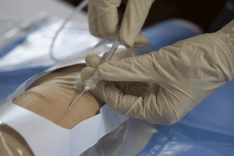 Técnica de Seldinger: quando utilizar o método clássico ou o método modificado 1 Inserção de cateter venoso utilizando a técnica de Seldinger em acesso vascular periférico.
