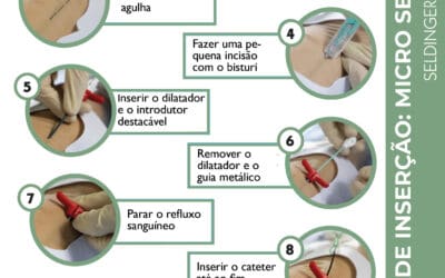 Técnica Micro Seldinger: passo a passo da inserção de cateter
