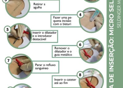 Técnica Micro Seldinger: passo a passo da inserção de cateter