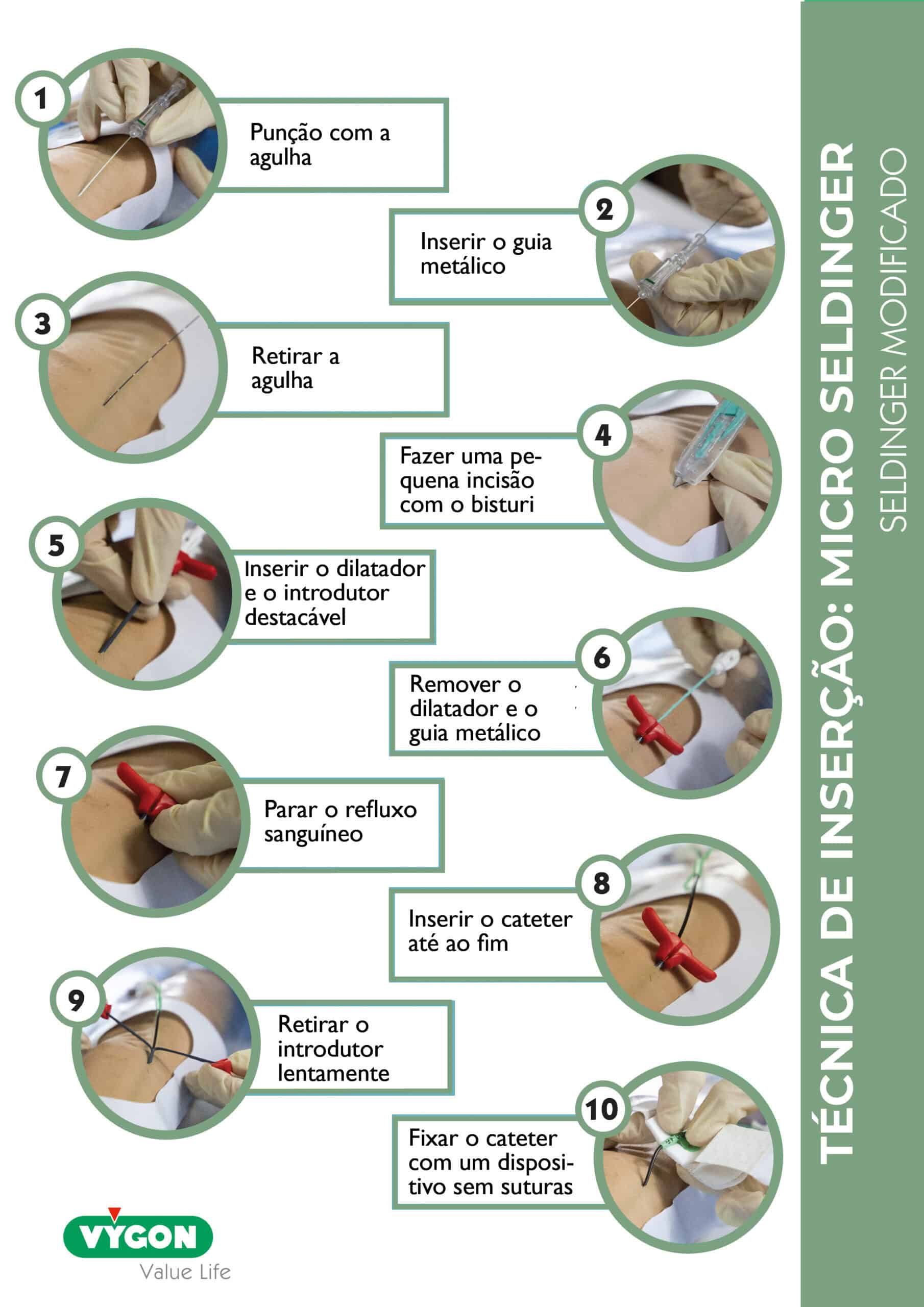 Infografia da técnica Micro Seldinger mostrando inserção de cateter com guia metálico, dilatador e introdução final do dispositivo.