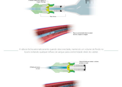 Como funciona um dispositivo anti‑refluxo
