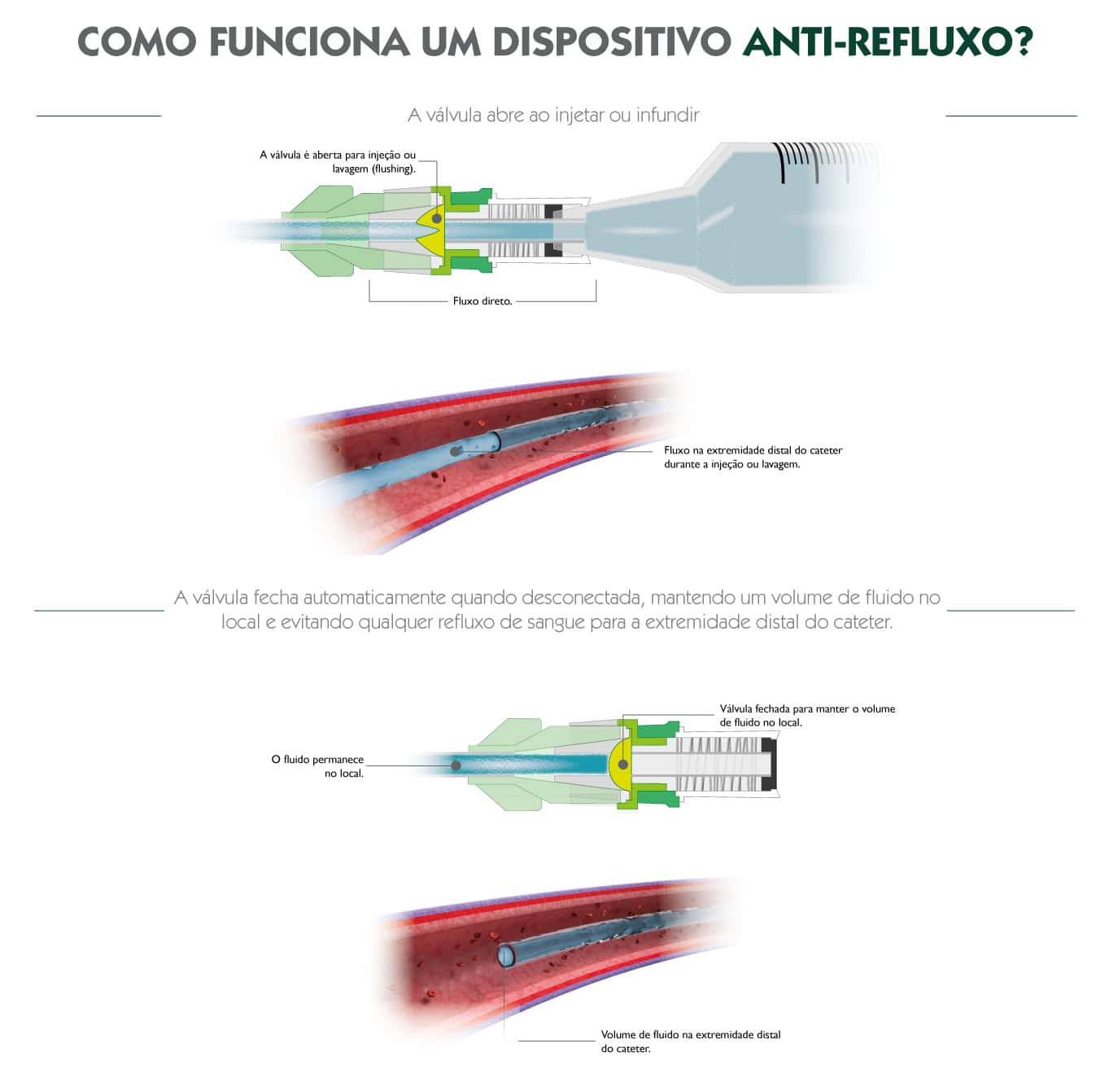Infografia do funcionamento de um dispositivo anti‑refluxo, mostrando abertura da válvula durante a infusão e fecho para prevenir refluxo de sangue.