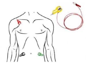 Localização da ponta do cateter PICC utilizando sistema de ECG com ligação intracavitária.