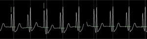 How to locate the tip of a PICC ECG2